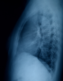 Original X-ray image before enhancement in PACS system